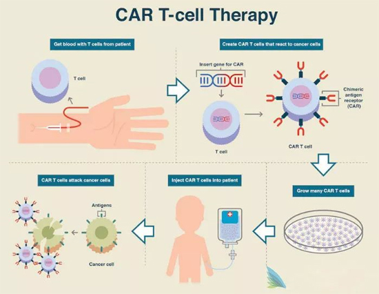 CAR-T细胞疗法